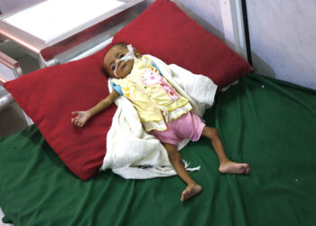 HODEIDAH, Seorang anak yang menderita malnutrisi akut terbaring di ranjang rumah sakit al-Thawrah di Hodeidah, kota pelabuhan Laut Merah di Yaman, pada 20 November 2021. (Xinhua/Mohammed Mohammed)