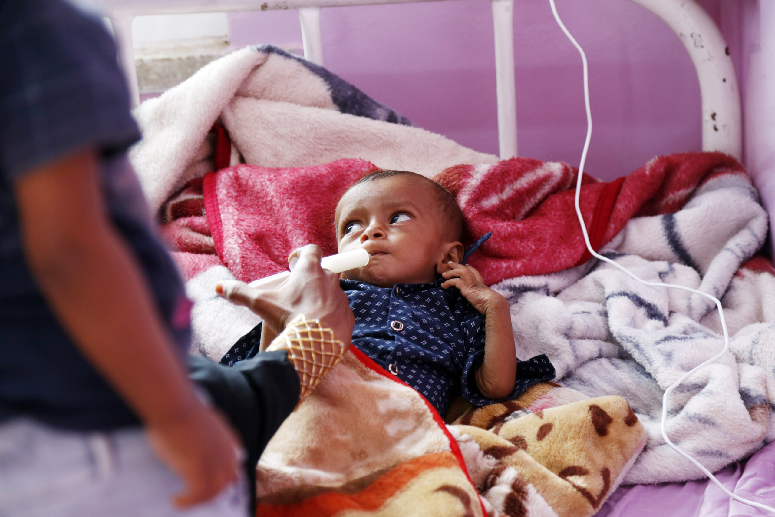 SANAA, Seorang anak yang menderita malanutrisi dirawat di sebuah rumah sakit di Sanaa, Yaman, pada 29 Mei 2023. (Xinhua/Mohammed Mohammed)